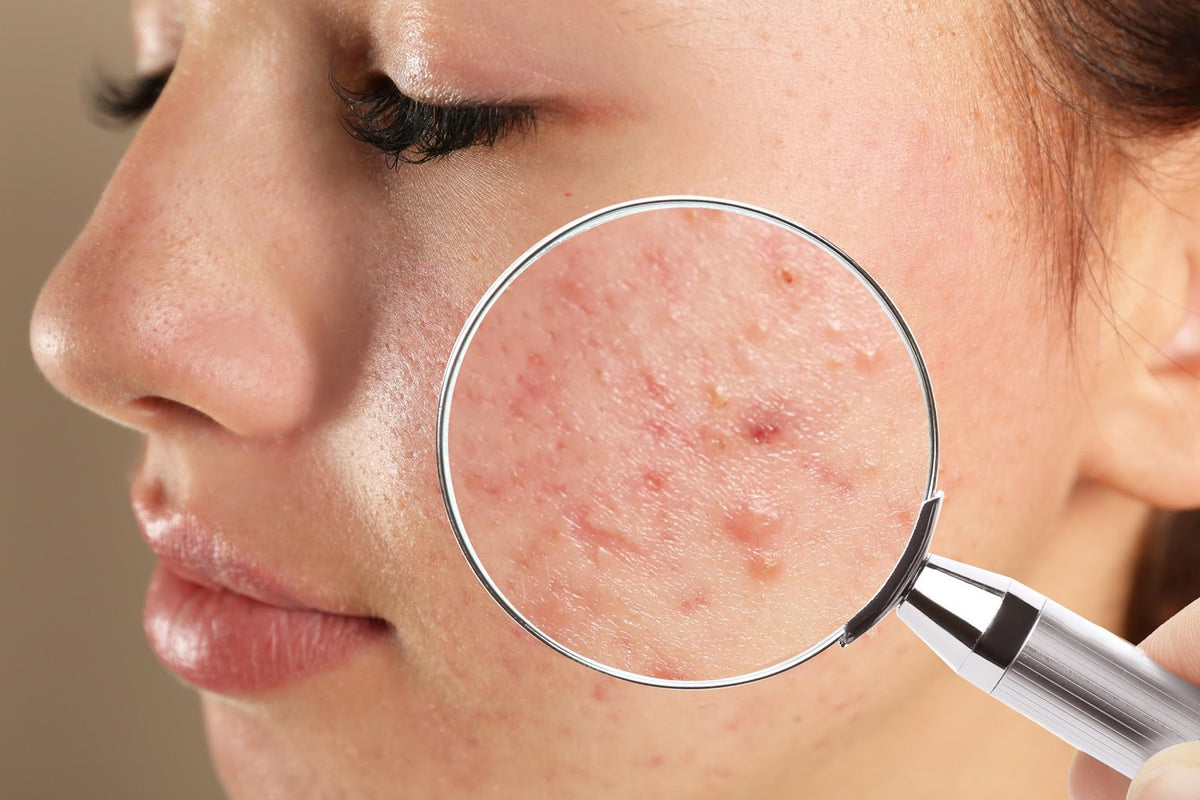 Understanding acne